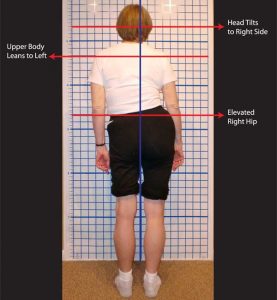 posture alignment therapy